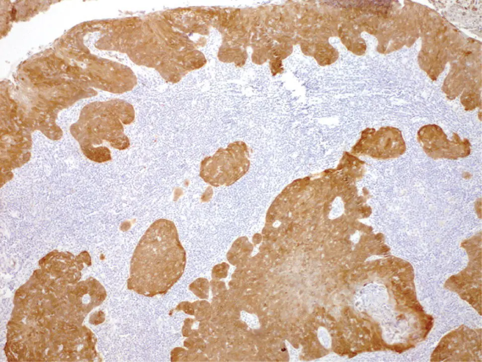 FIGURE 94 Histologic images of a poorly differentiated squamous cell carcinoma - фото 24
