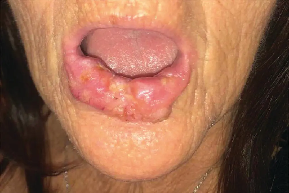 FIGURE 51 The patients lower lip mass The tumor extends from the right - фото 11