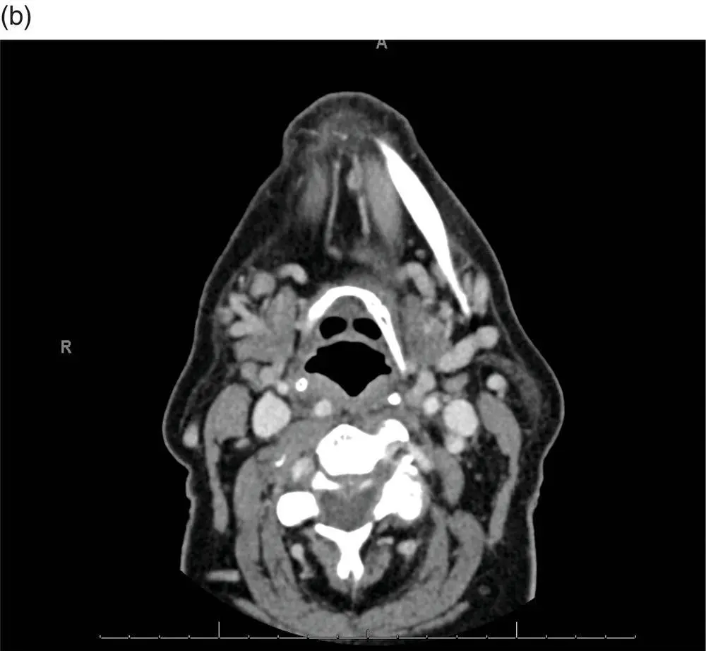 FIGURE 52 These representative axial cuts for the patients neck CT with IV - фото 13