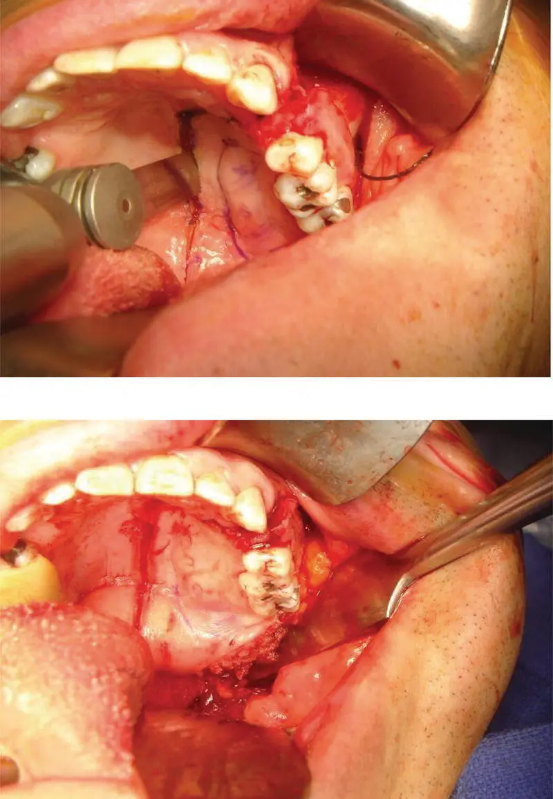 FIGURE 63 These intraoperative images show the surgical approach transorally - фото 18