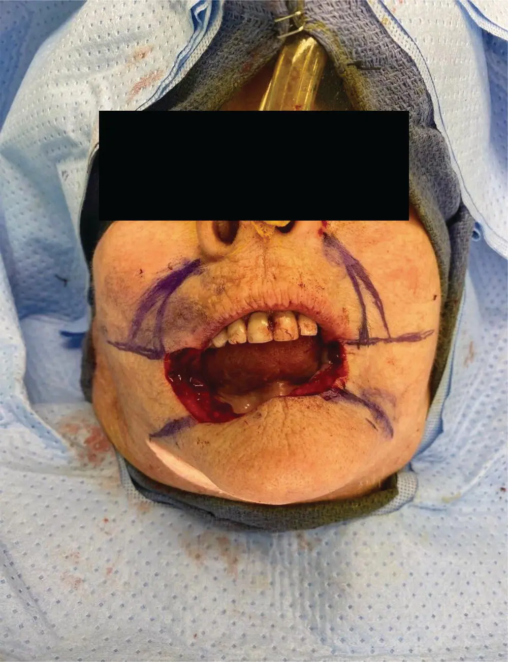 FIGURE 53 This intraoperative photo shows the patients total lower lip - фото 14