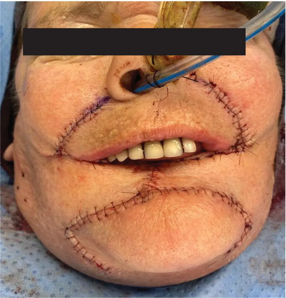 FIGURE 54 BernardWebster bilateral advancement flap reconstruction The - фото 15