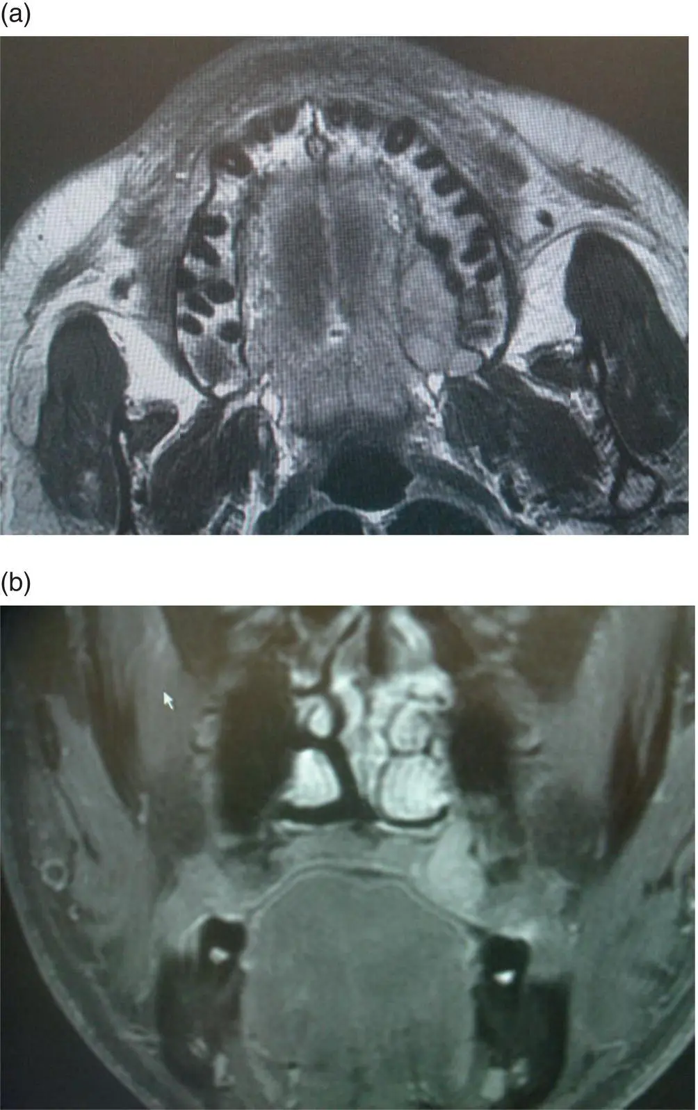 FIGURE 62 An axial T1weighted MRI image without contrast a and a coronal - фото 17