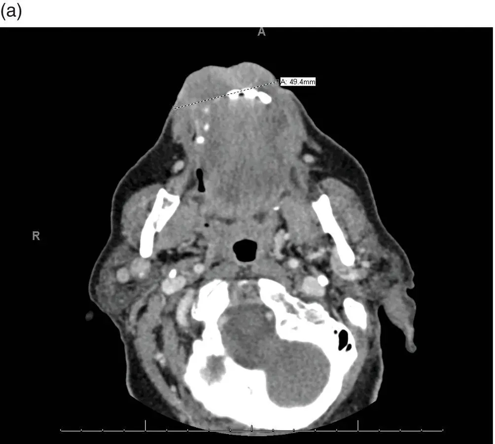 FIGURE 52 These representative axial cuts for the patients neck CT with IV - фото 12