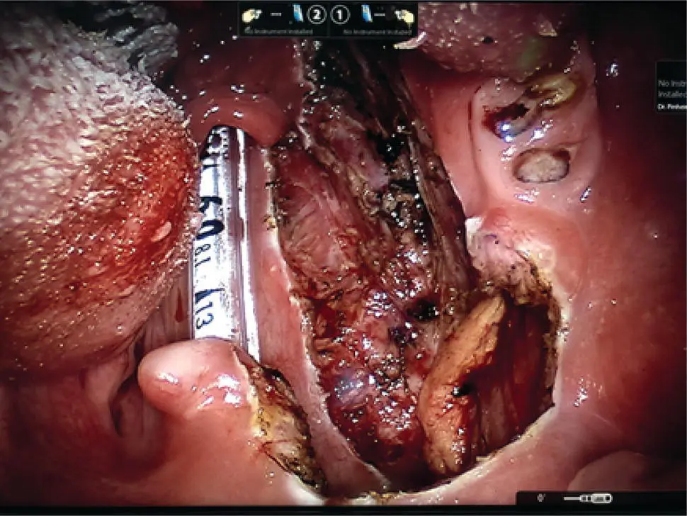 FIGURE 113 This intraoperative photo shows the resection bed following a - фото 28