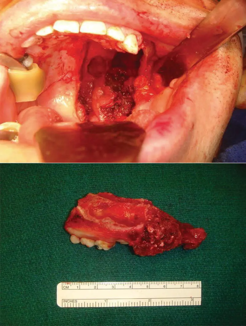 FIGURE 63 These intraoperative images show the surgical approach transorally - фото 19
