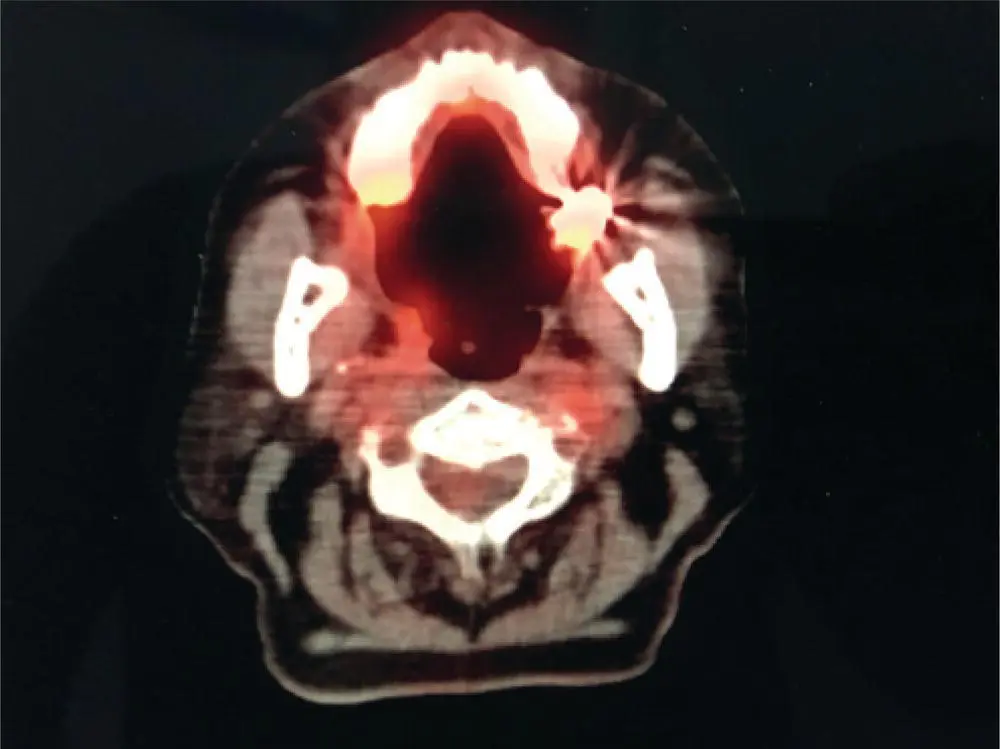 FIGURE 112 This is an axial cut of the patients PETCT There is slight soft - фото 27