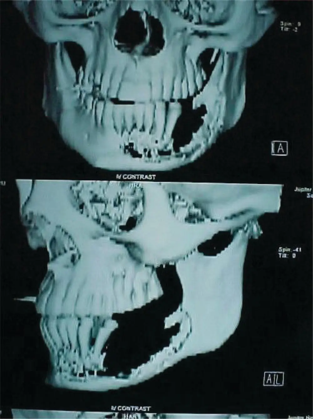 FIGURE 42 CT scan shows an extensive and destructive process of the left - фото 10