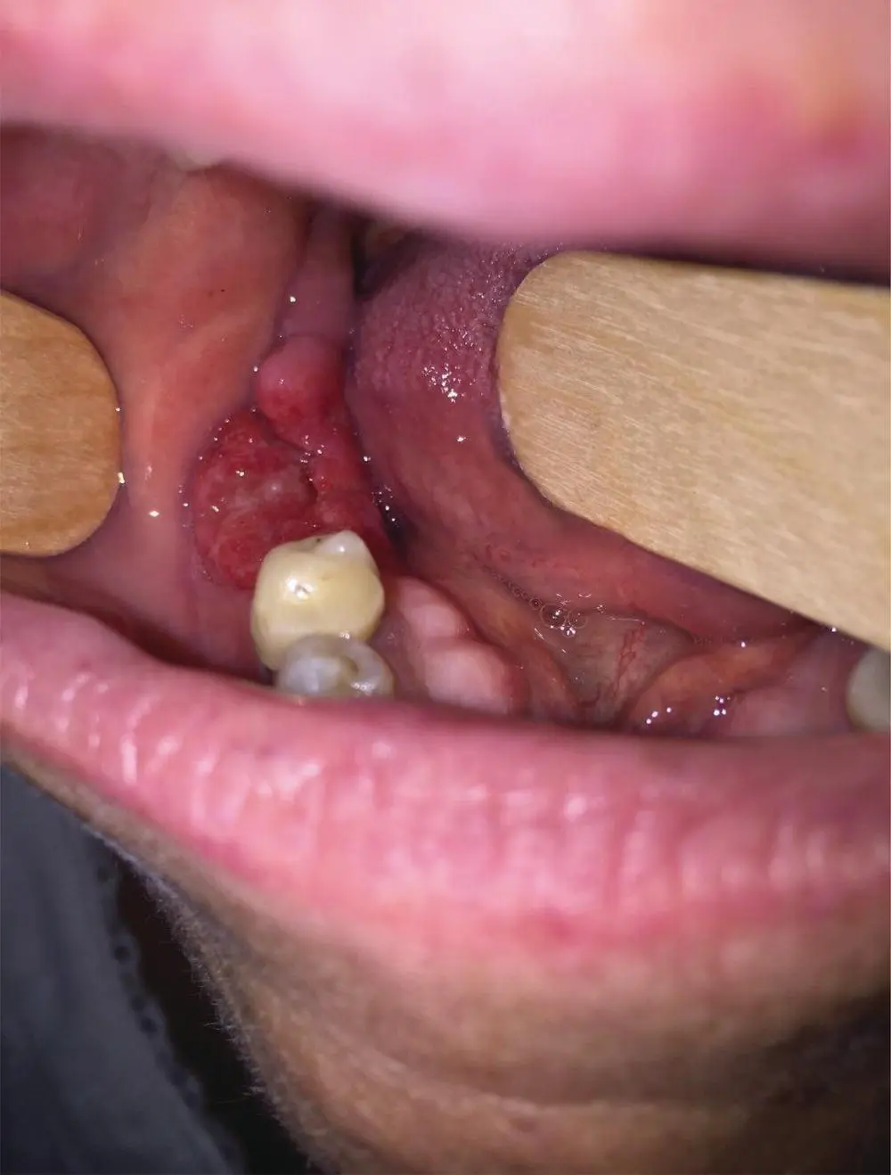 FIGURE 21 This photo demonstrates the ulcerative mucosal lesion of the right - фото 4