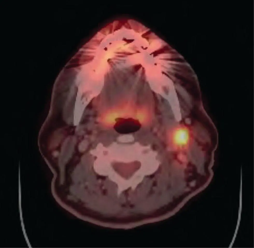 FIGURE 71 This is a fused axial image of a PETCT scan at the level of the - фото 21