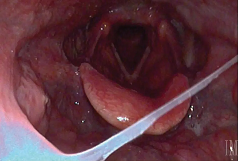 FIGURE 91 This image from a transnasal fiberoptic laryngoscopy shows no - фото 23