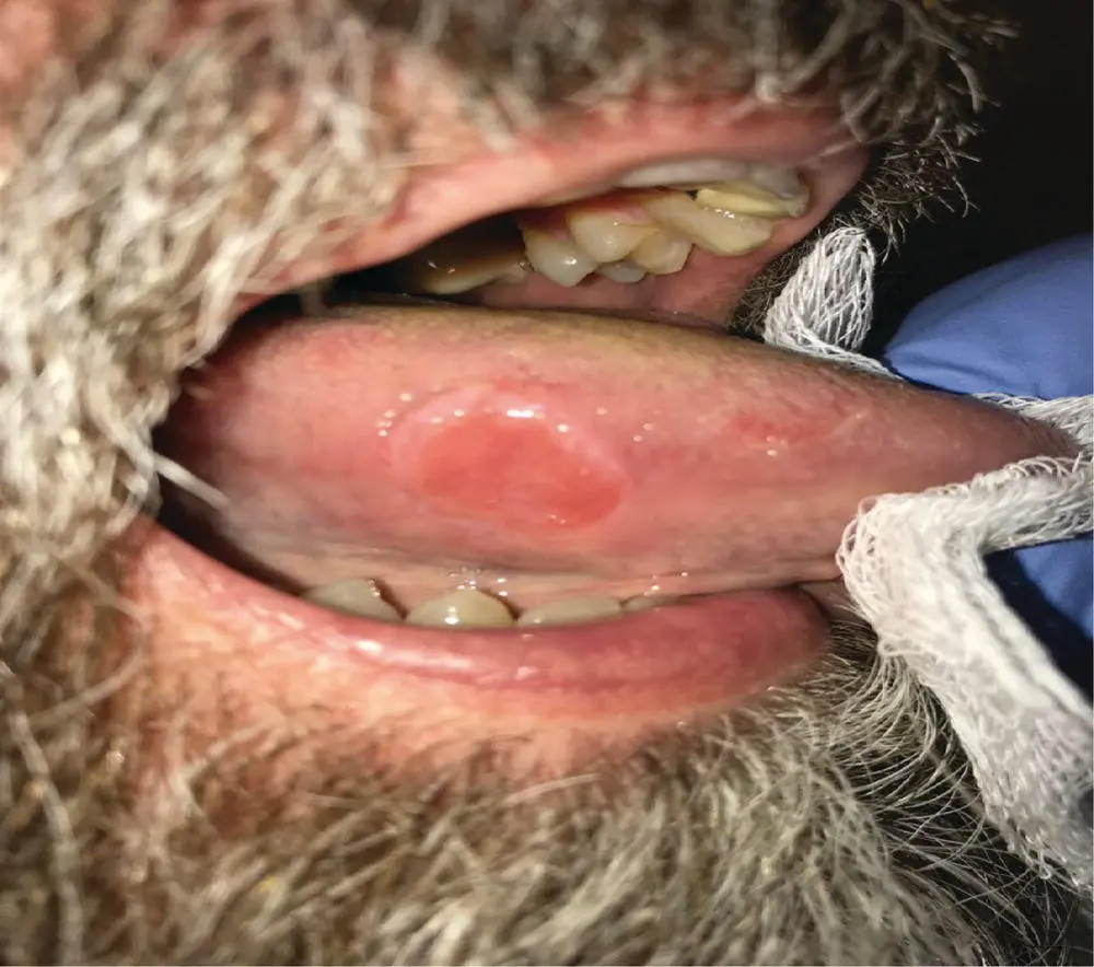 FIGURE 11 This photo demonstrates the patients right lateral tongue - фото 2