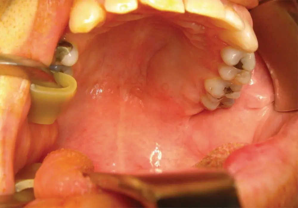 FIGURE 61 This transoral photograph shows mild submucosal fullness of the left - фото 16