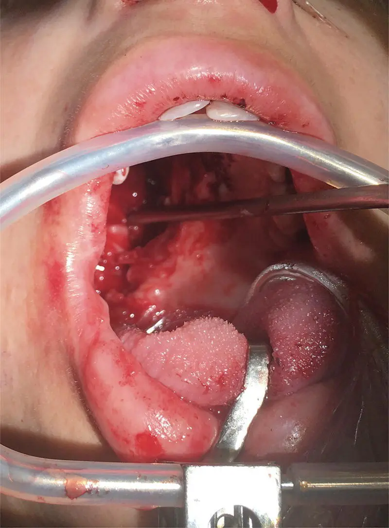 FIGURE 33 Intraoperative photo of the right oral cavity defect after surgical - фото 8