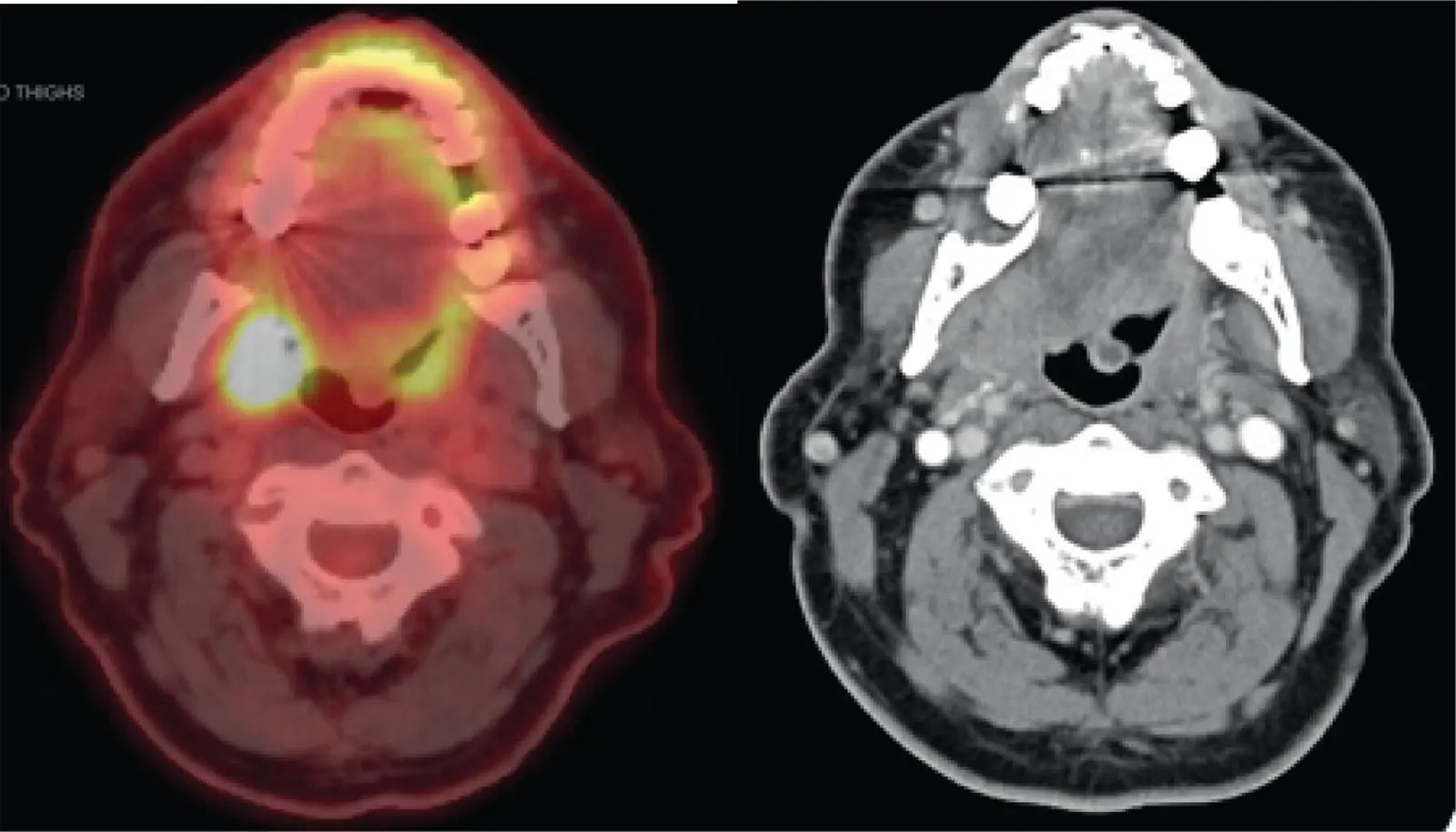 FIGURE 81 These axial images of the fused PETCT left and CT of the neck - фото 22