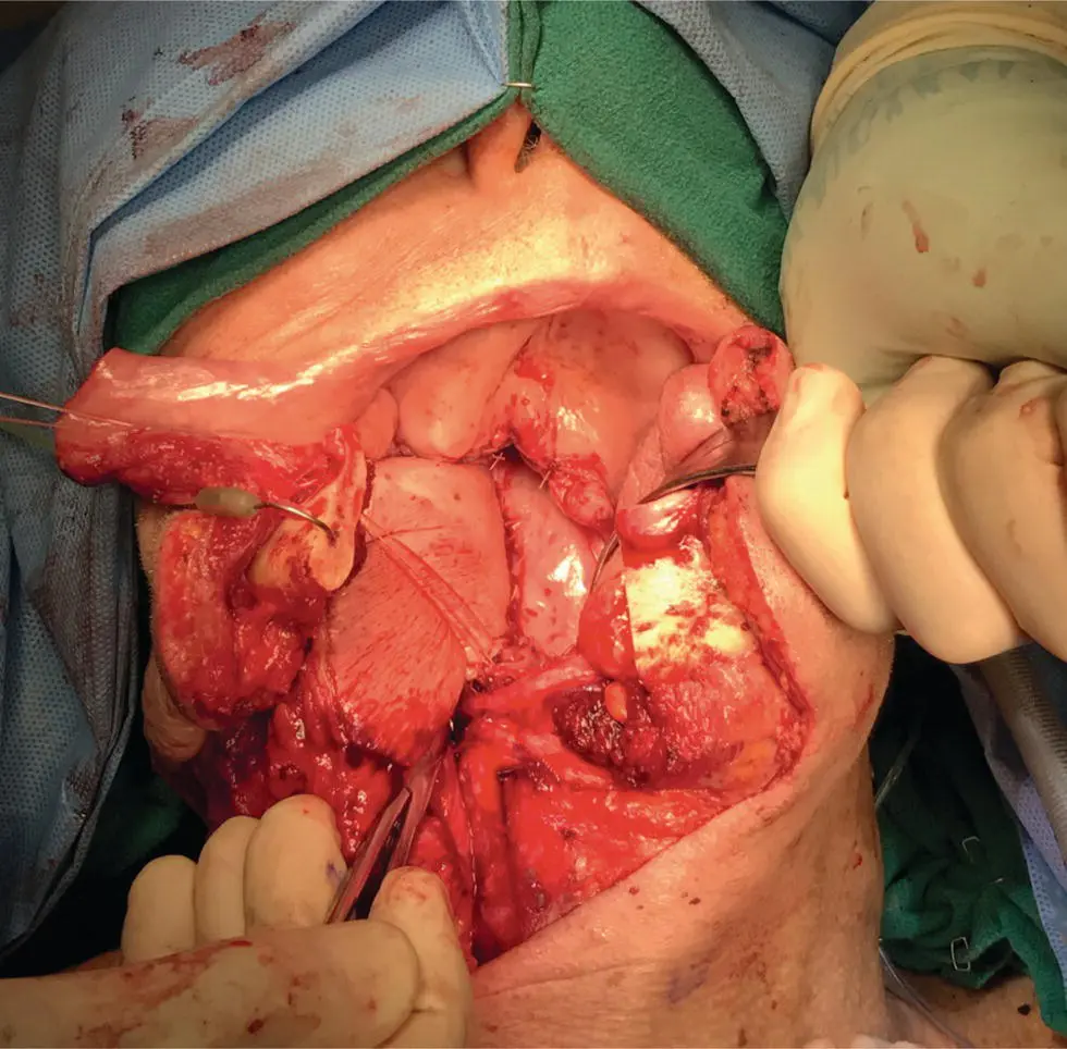 FIGURE 103 This intraoperative photo demonstrates an open approach to the - фото 25
