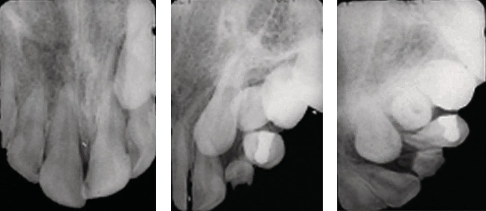 Fig 44 The left periapical view oriented for the central incisors shows the - фото 42