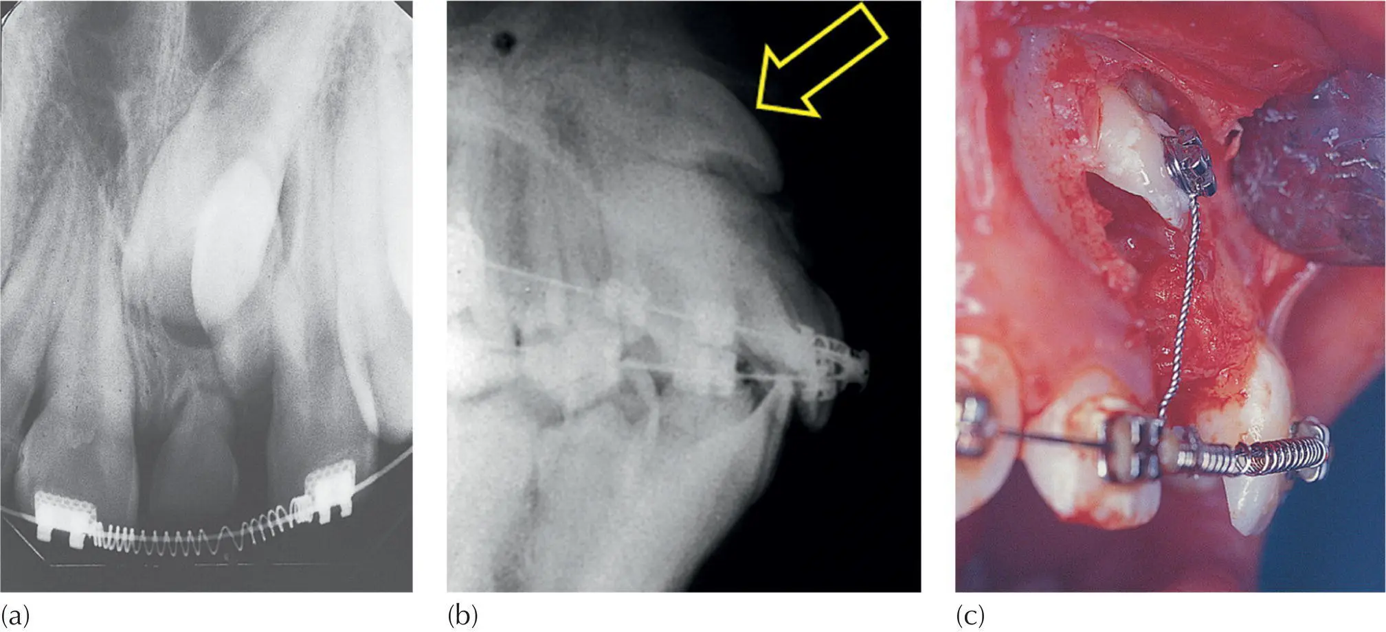 Fig 43 a The periapical view shows an impacted left maxillary central - фото 41