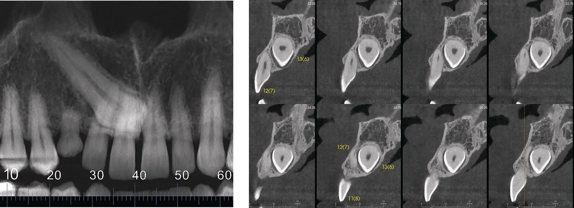 Fig 416 Diagnosing resorption crosssections The lateral incisor 127 is - фото 54