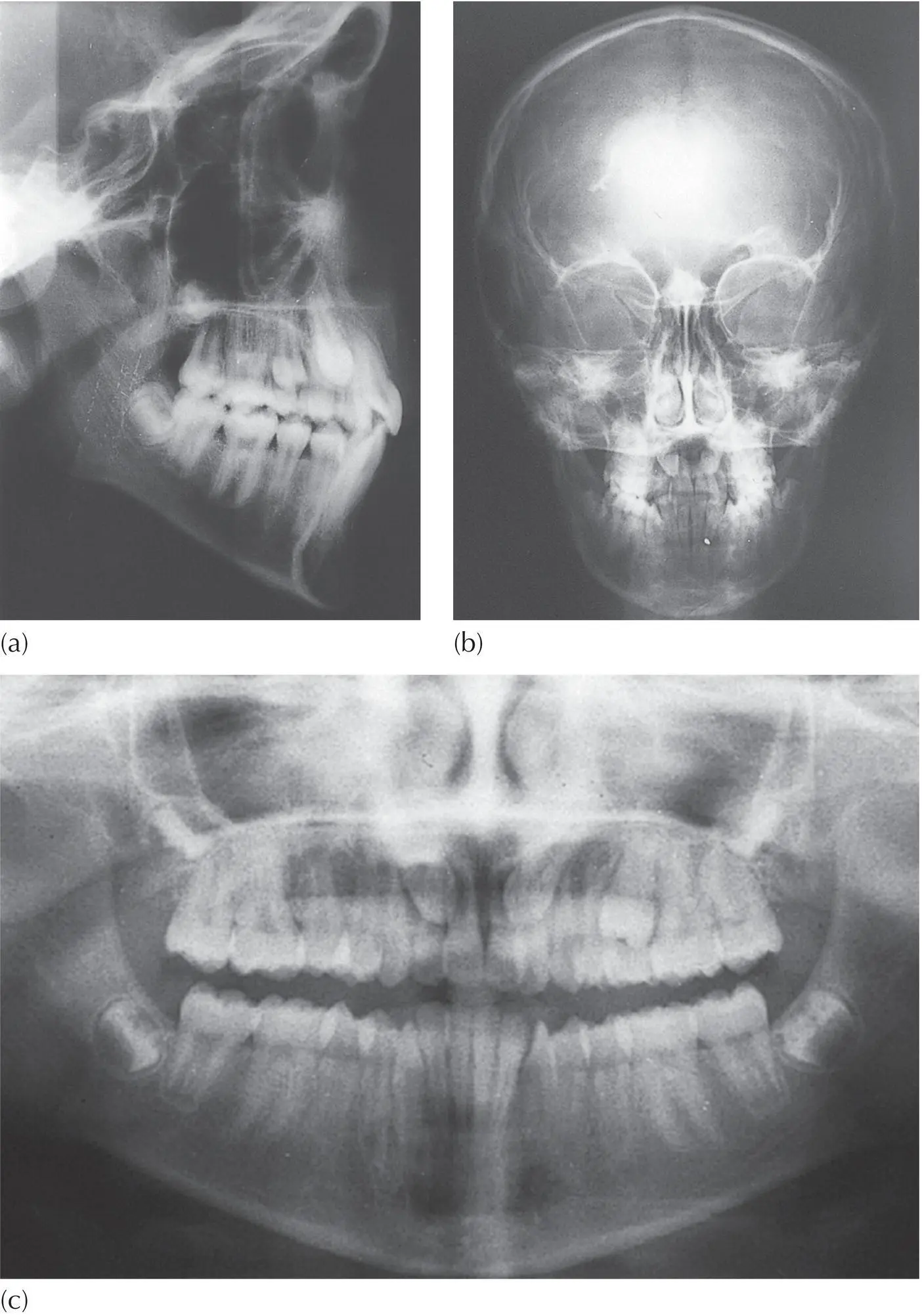 Fig 410 a The true lateral cephalometric radiograph shows both canines - фото 48