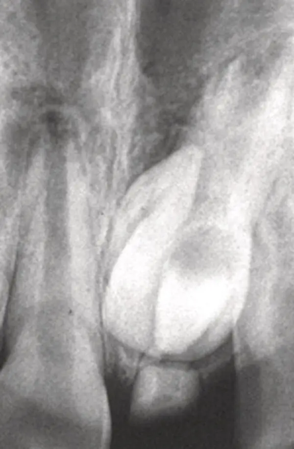 Fig 110 An 8yearold child exhibits an unerupted maxillary left central - фото 11