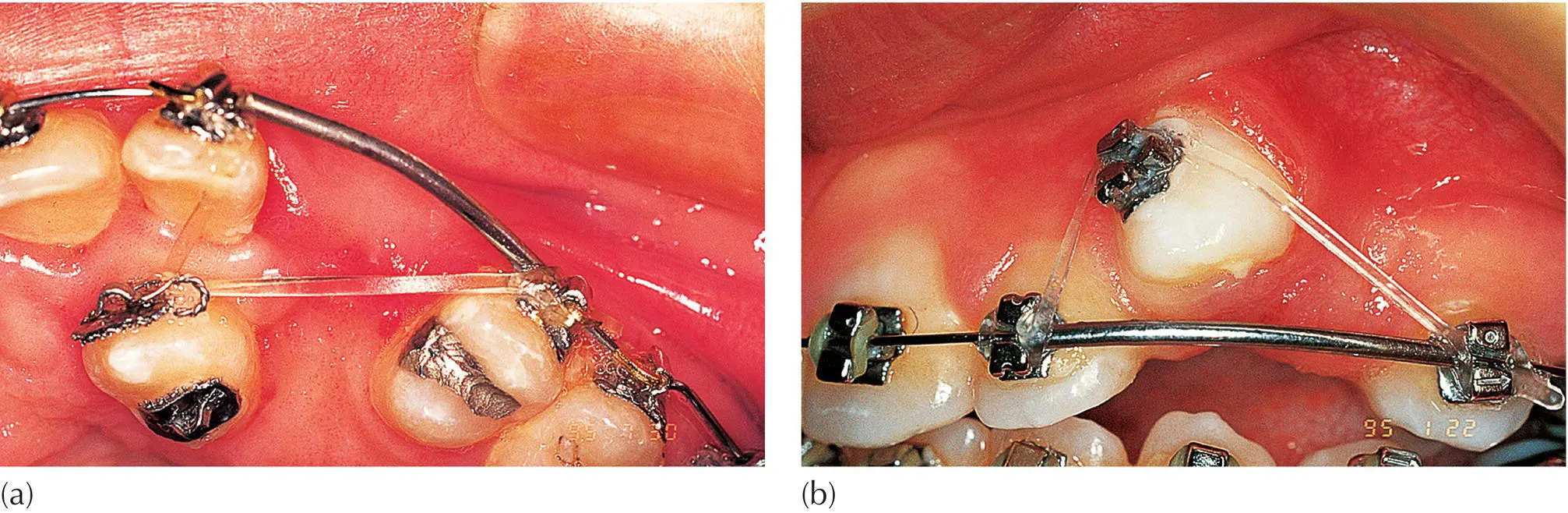 Fig 26 a The slingshot elastic A palatally impacted canine has erupted - фото 17