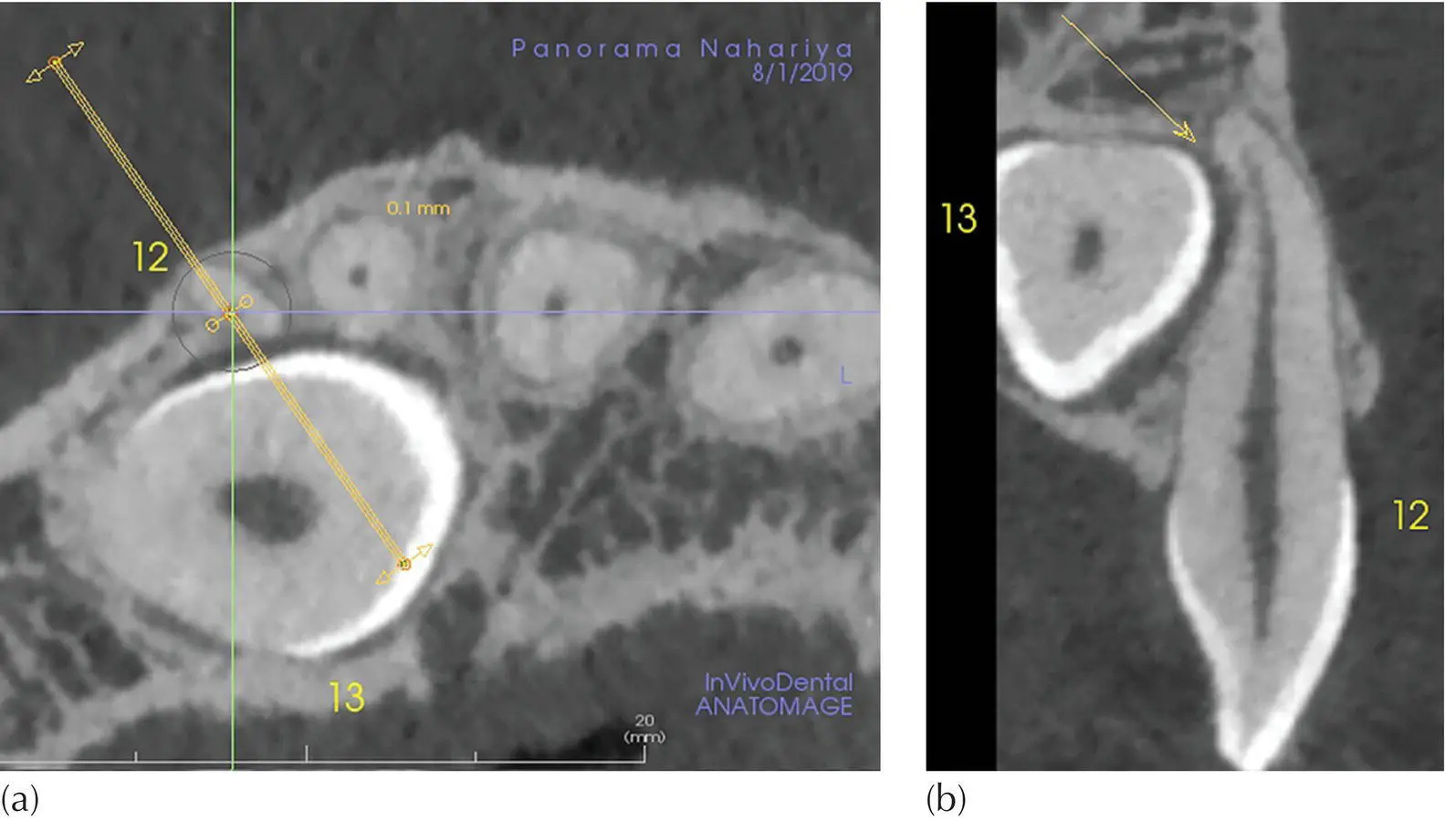 Fig 418 Diagnosing resorption with multiplanar reconstruction MPR The - фото 56