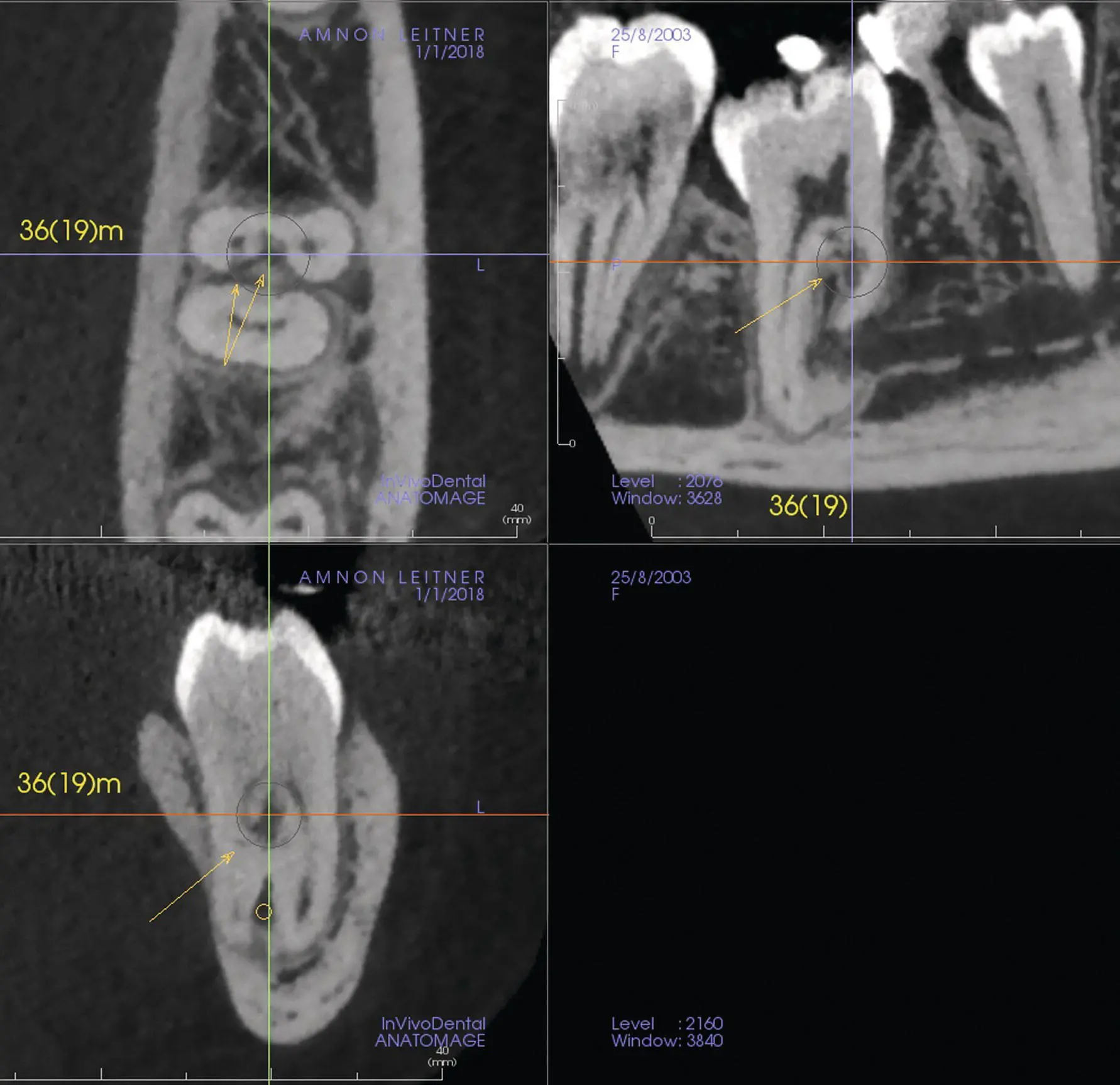 Fig 421 Multiplanar reconstruction view Arrows indicate the invasive - фото 59