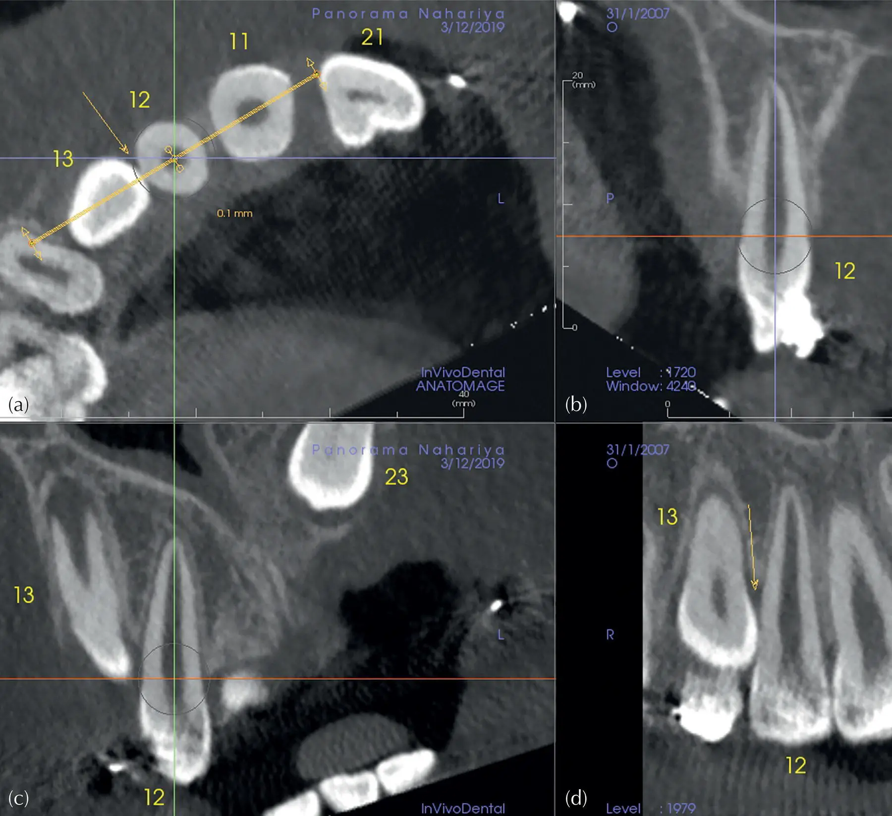 Fig 414 A view of the multiplanar reconstruction screen for Case 1 as - фото 52