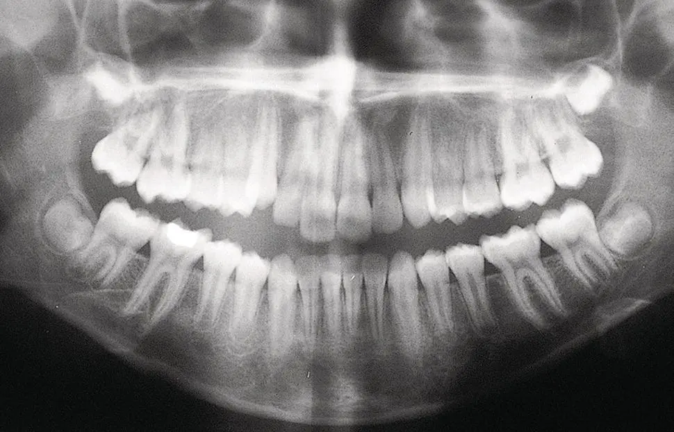 Fig 14 Root apices are closed in all first molars all mandibular and three - фото 5