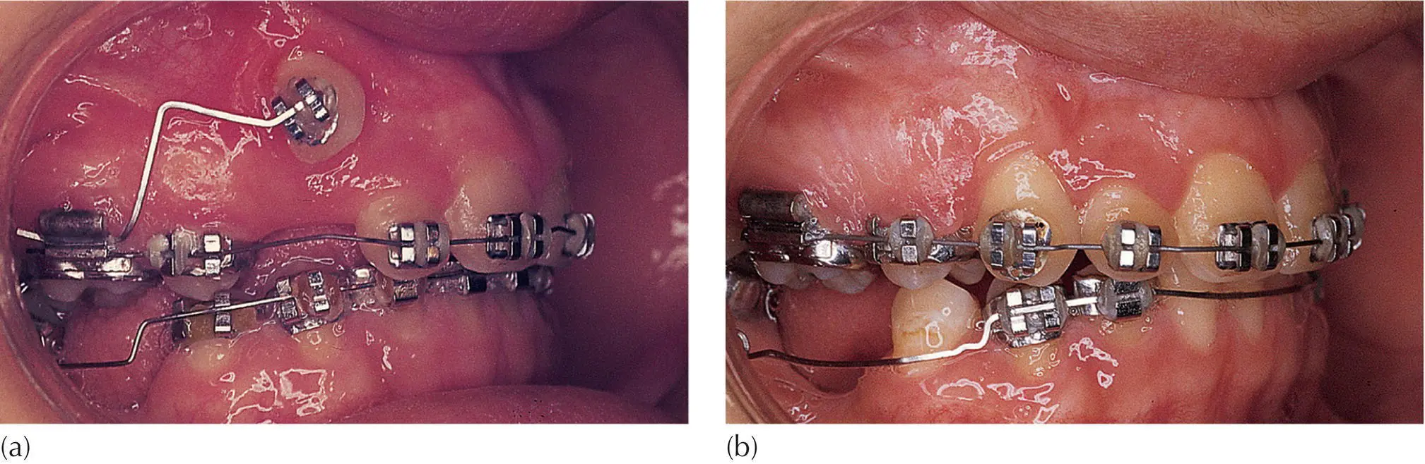 Fig 54 a A high buccal canine exposed by circular incision in the very wide - фото 63