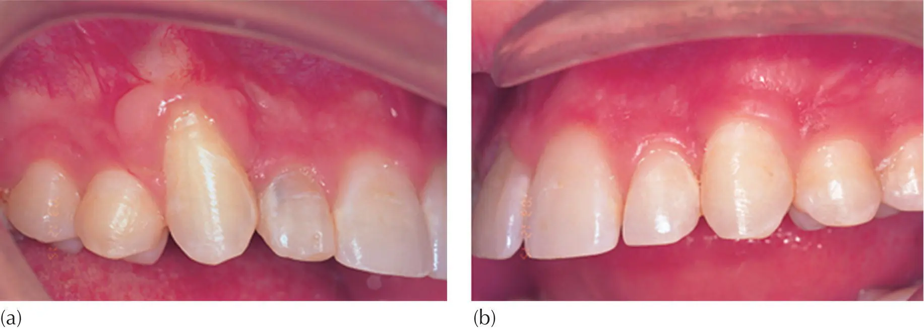 Fig 57 Treatment for the right buccally impacted maxillary canine was - фото 66