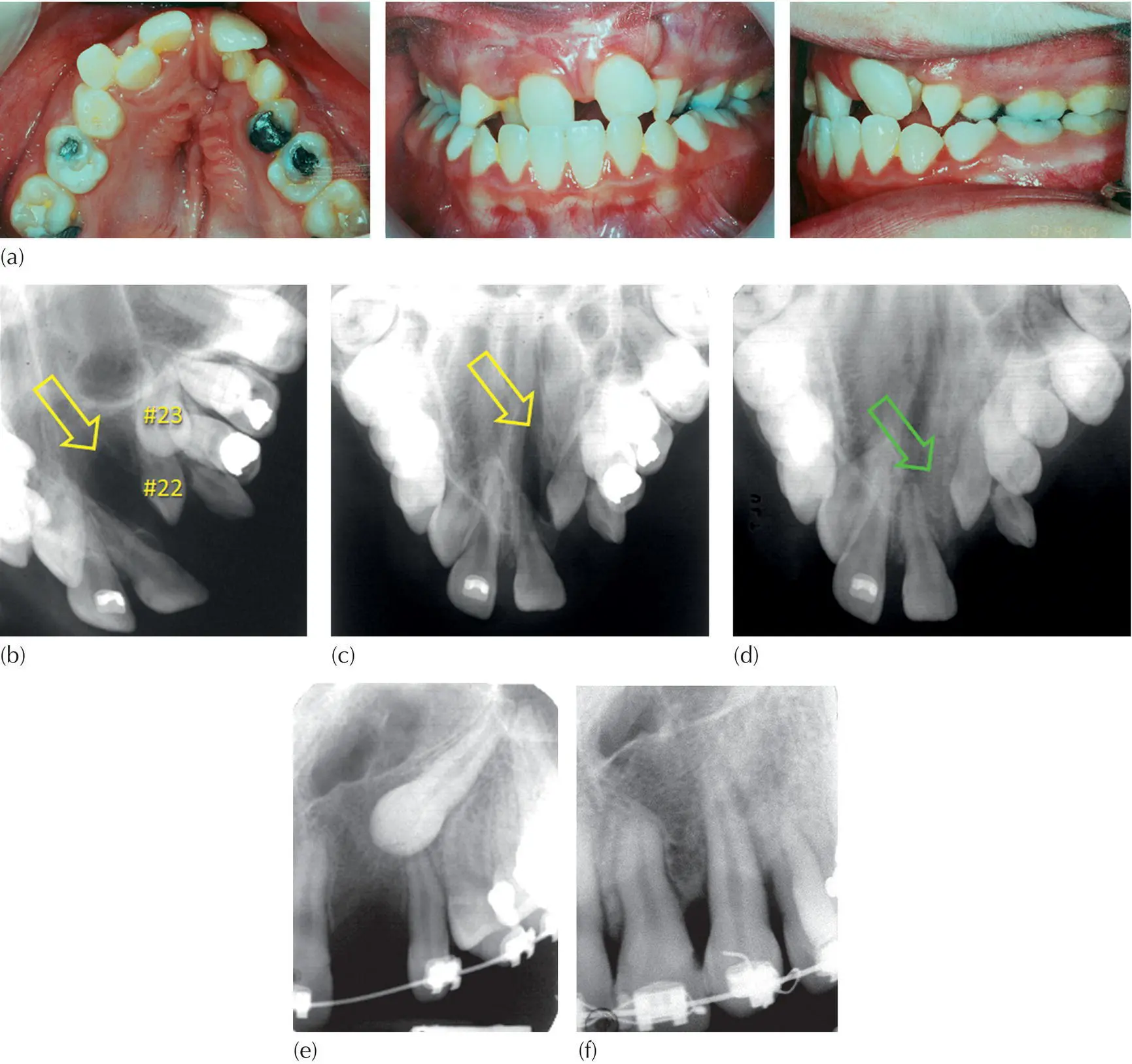 Fig 510 a The initial records of the dentition showing the narrowed - фото 69