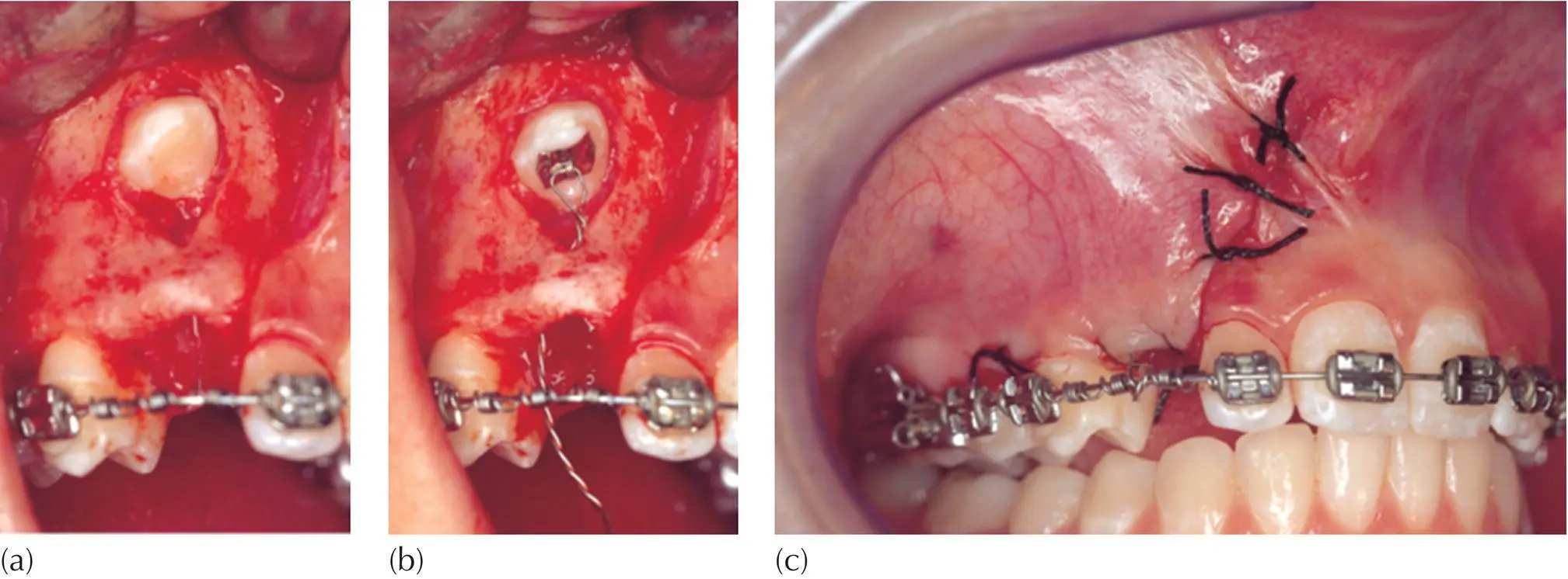Fig 55 Crescinis tunnel variation of the closed eruption technique a A - фото 64