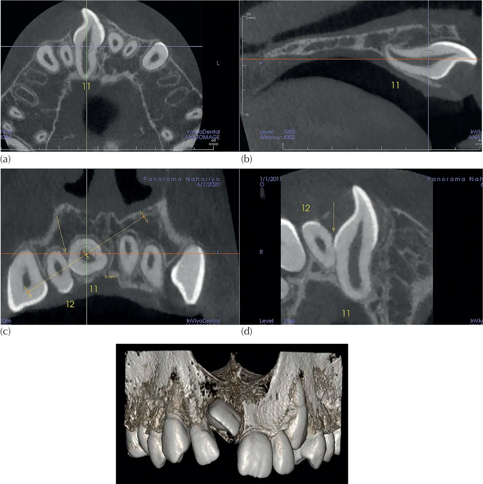 Fig 419 Multiplanar reconstruction for an incisor that is almost horizontal - фото 57