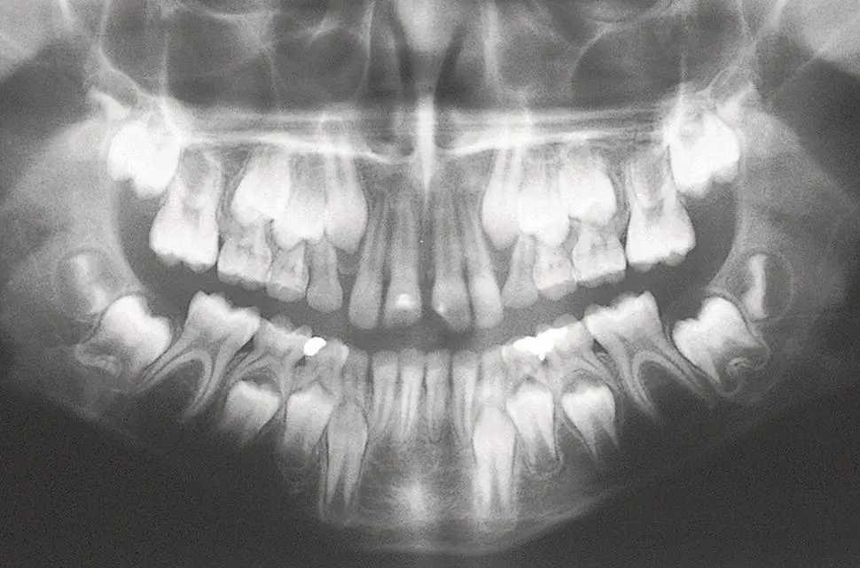 Fig 12 A 12yearold patient with root development indicating the late dental - фото 4
