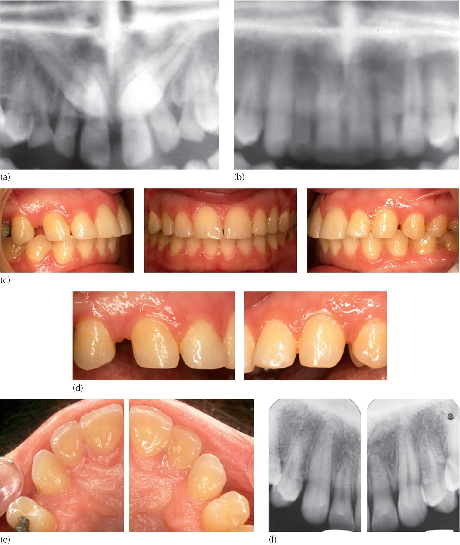 Fig 511 A case of bilateral palatal impaction of maxillary canine treatment - фото 71