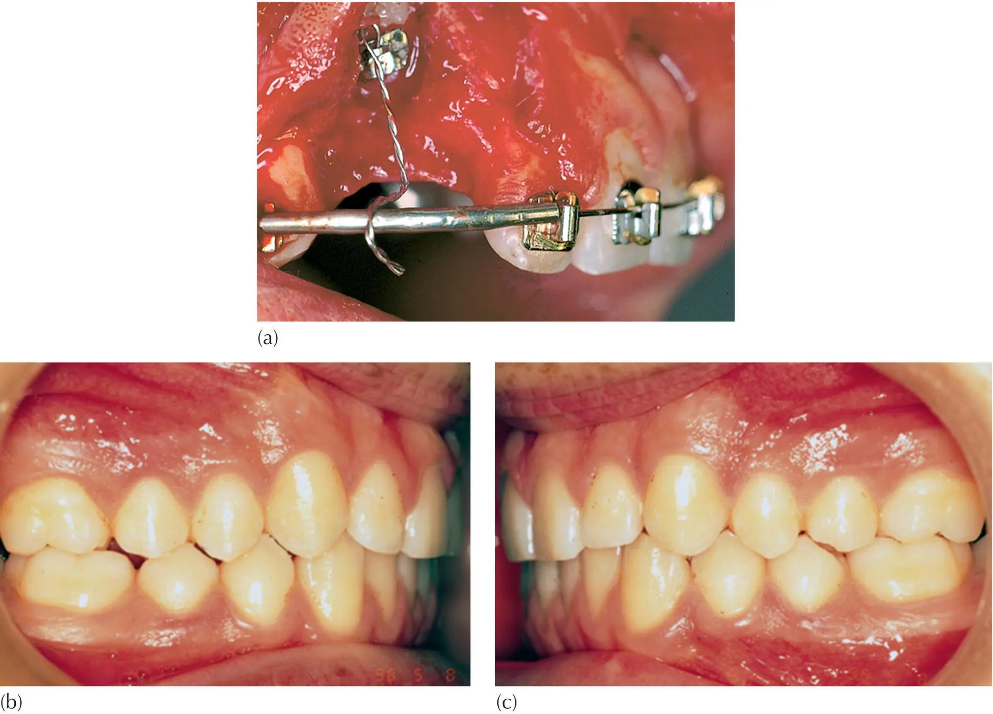 Fig 512 a Mild palatal displacement of the right maxillary canine located - фото 72