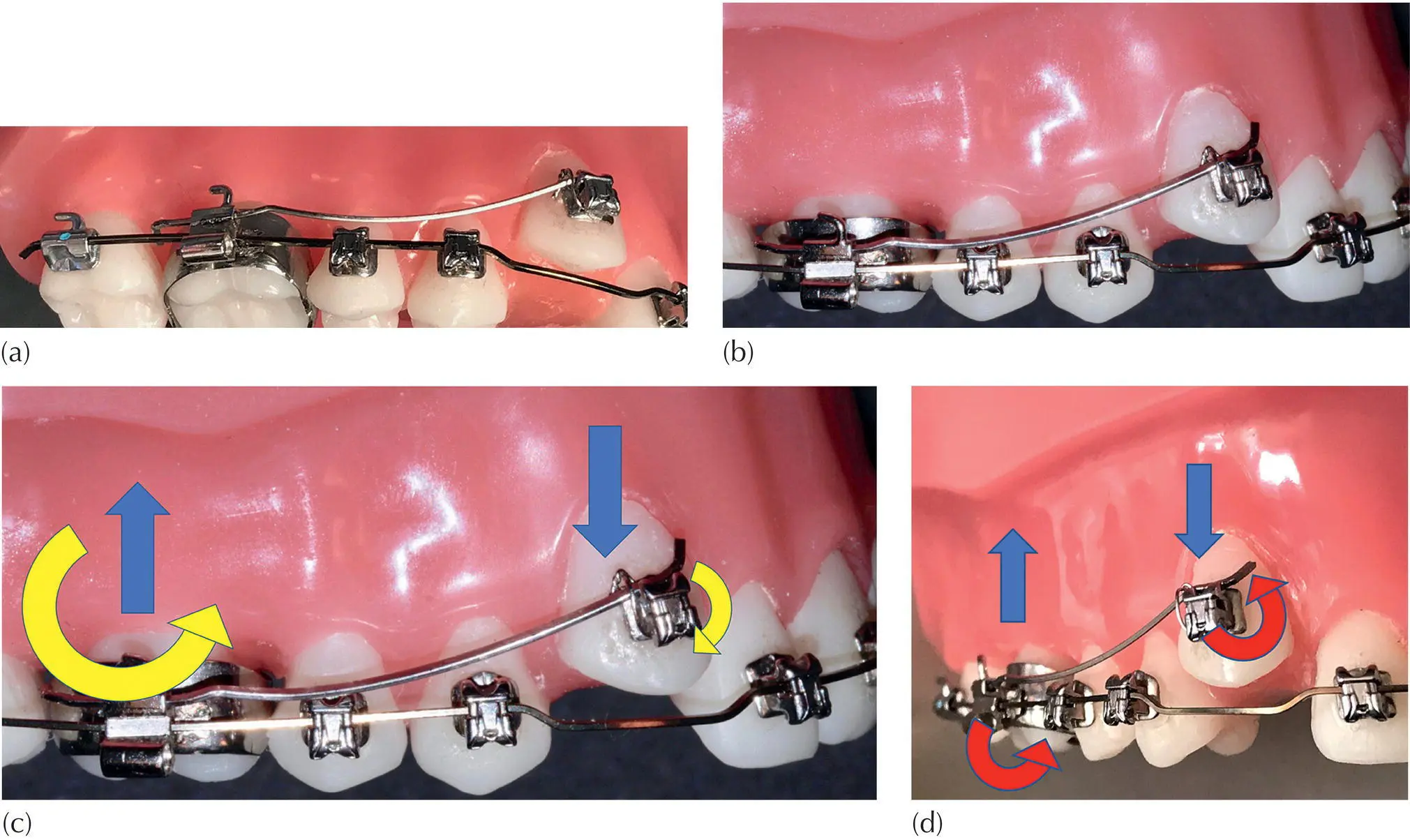 Fig 31 a Buccal cantilever for extruding a canine In practice an eyelet - фото 22