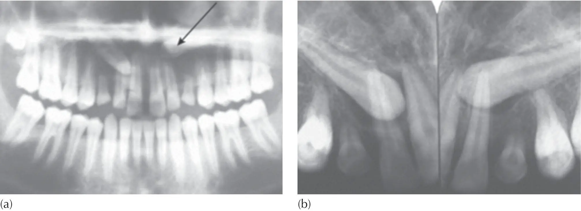 Fig 46 The vertical tube shift method using a panoramic radiograph and - фото 44