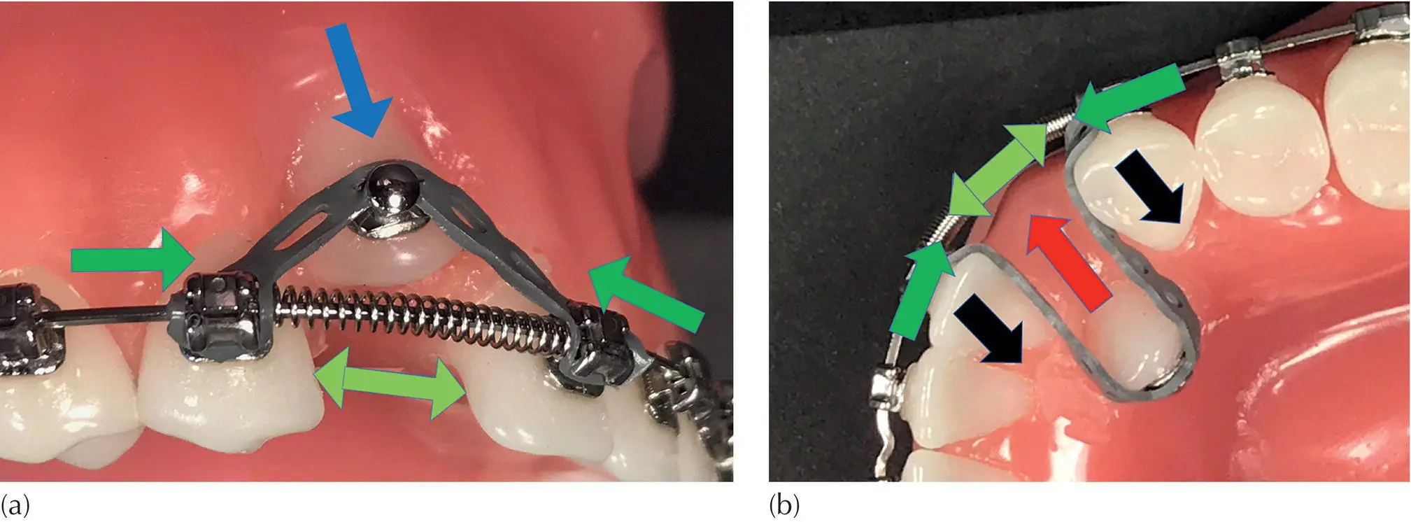 Fig 36 a b Using an elastomeric chain is relatively simple and - фото 27