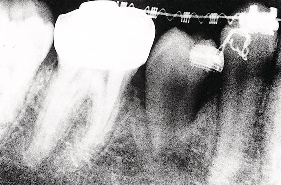 Fig 53 Following exposure attachment bonding and packing the unerupted - фото 62
