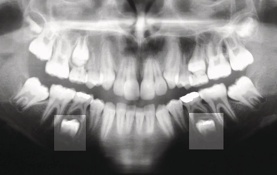Fig 16 Latedeveloping second mandibular premolars with retained not - фото 7