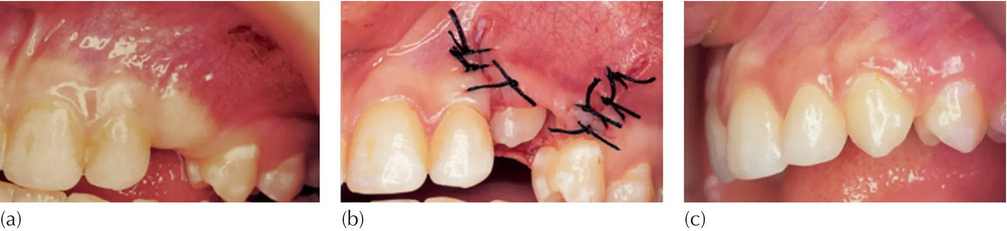 Fig 51 a A 16yearold female exhibits an unerupted maxillary left canine - фото 60