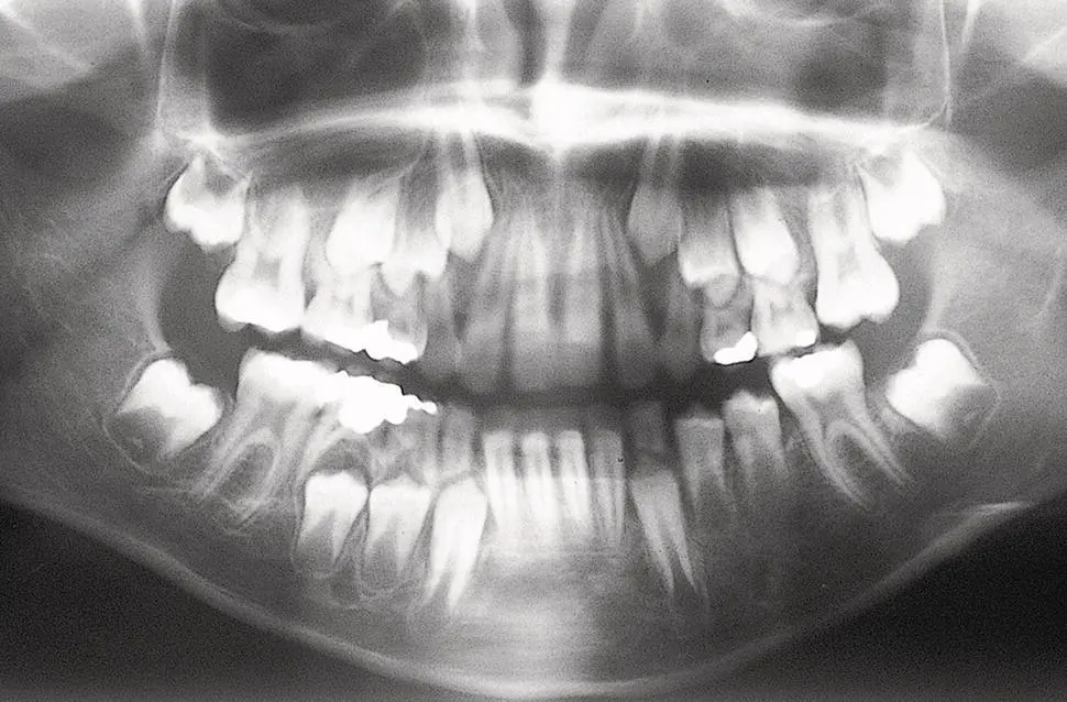 Fig 17 The left mandibular premolars are prematurely erupted with - фото 8