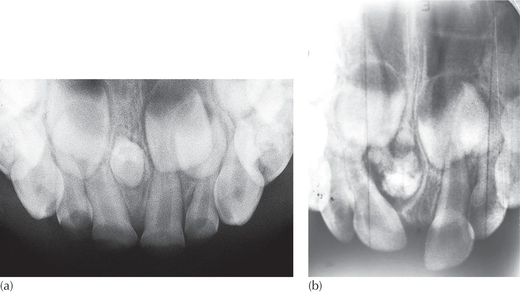 Fig 19 a Chance finding of mesiodens in a 4yearold child b Chance - фото 10