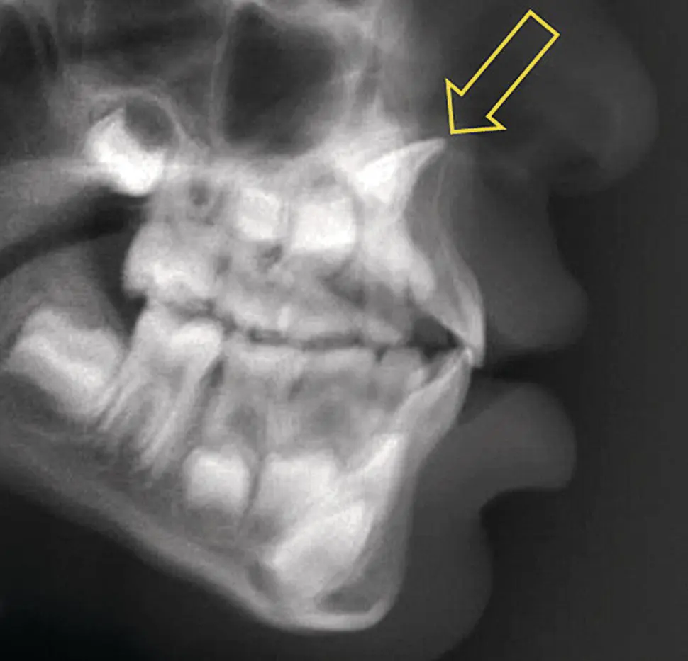 Fig 412 A dilacerated central incisor arrow seen in a lateral cephalometric - фото 50