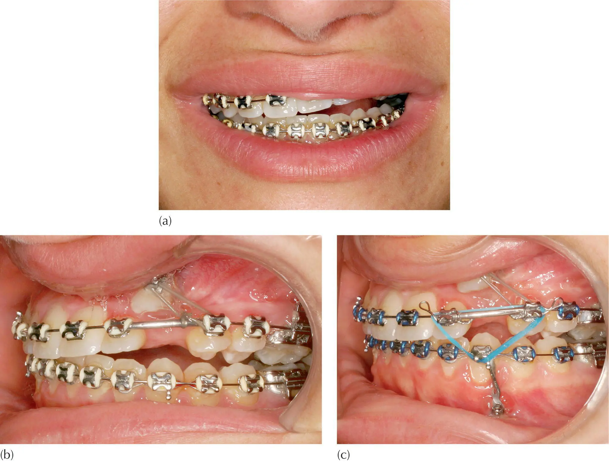 Fig 28 An indirect anchorage system a Extraoral view to show tipped - фото 19
