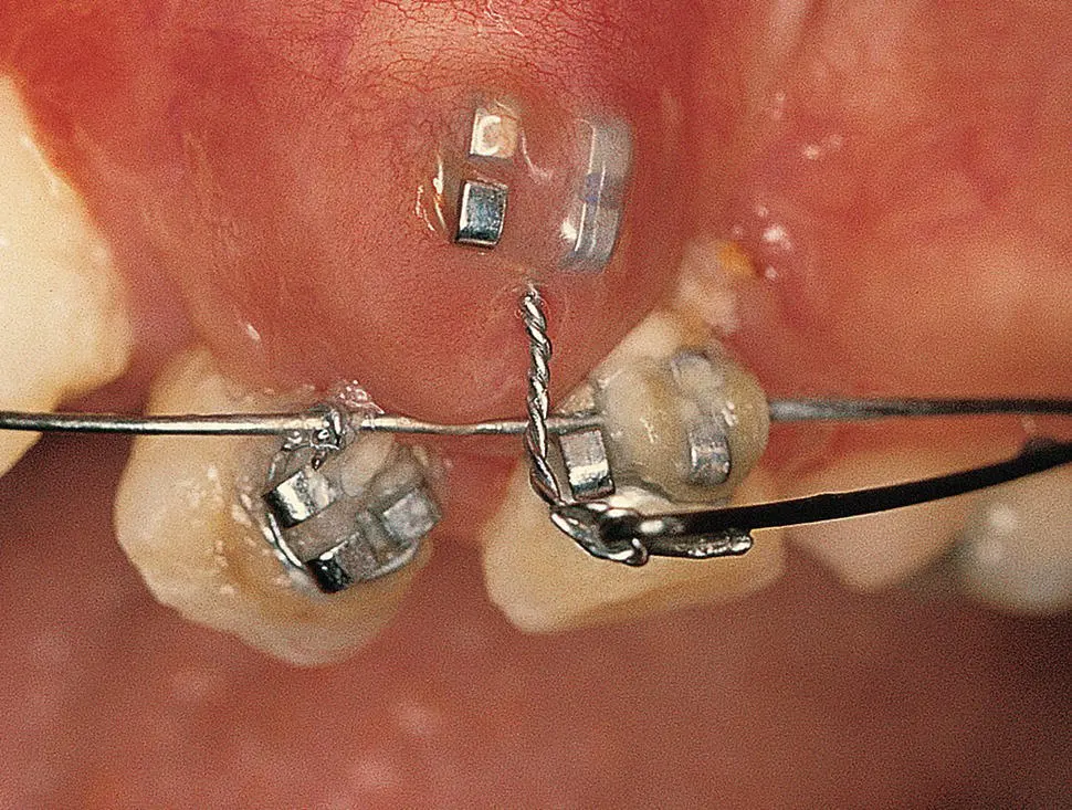 Fig 23 As the impacted tooth is about to erupt the highprofile Siamese - фото 14