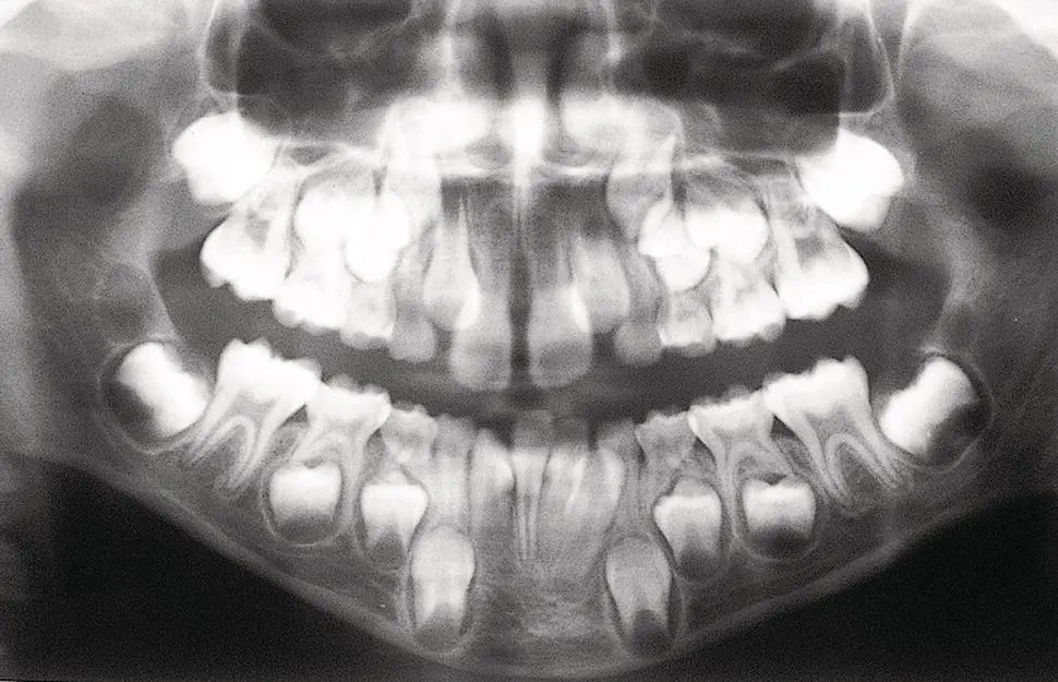 Fig 15 No closed apices Dental age assessment 775 years By way of - фото 6